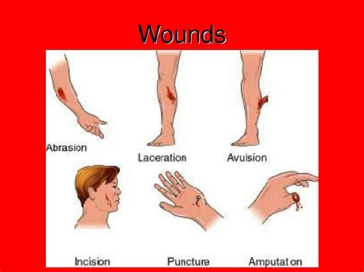 avulsion wound