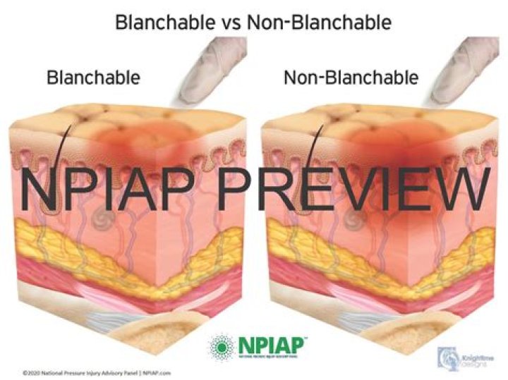 blanchable