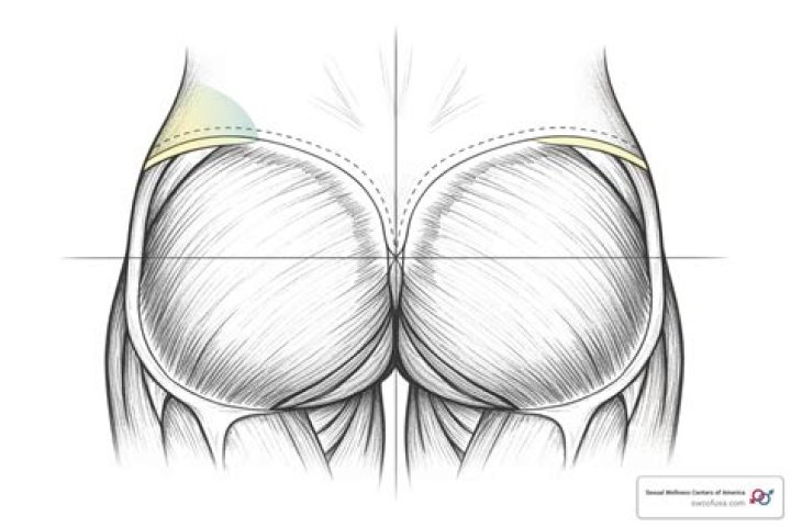 dorsogluteal site
