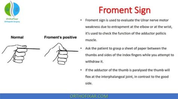 froment’s sign