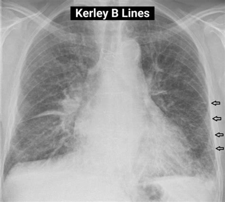 kerley b lines