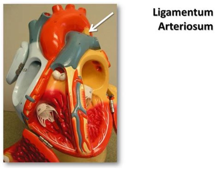 ligamentum arteriosum
