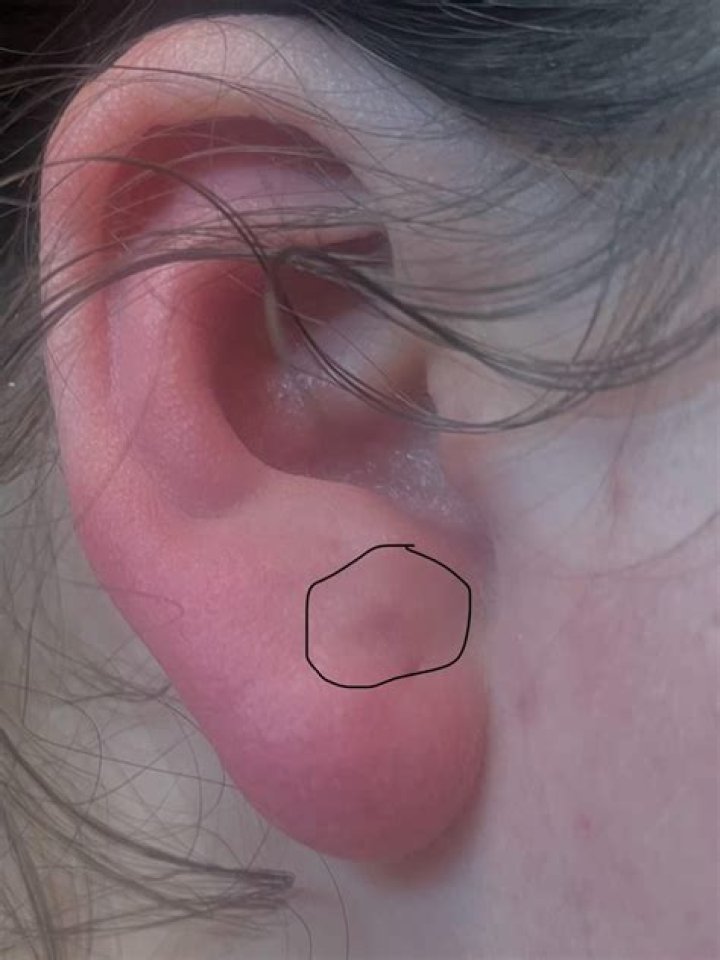 lump in earlobe