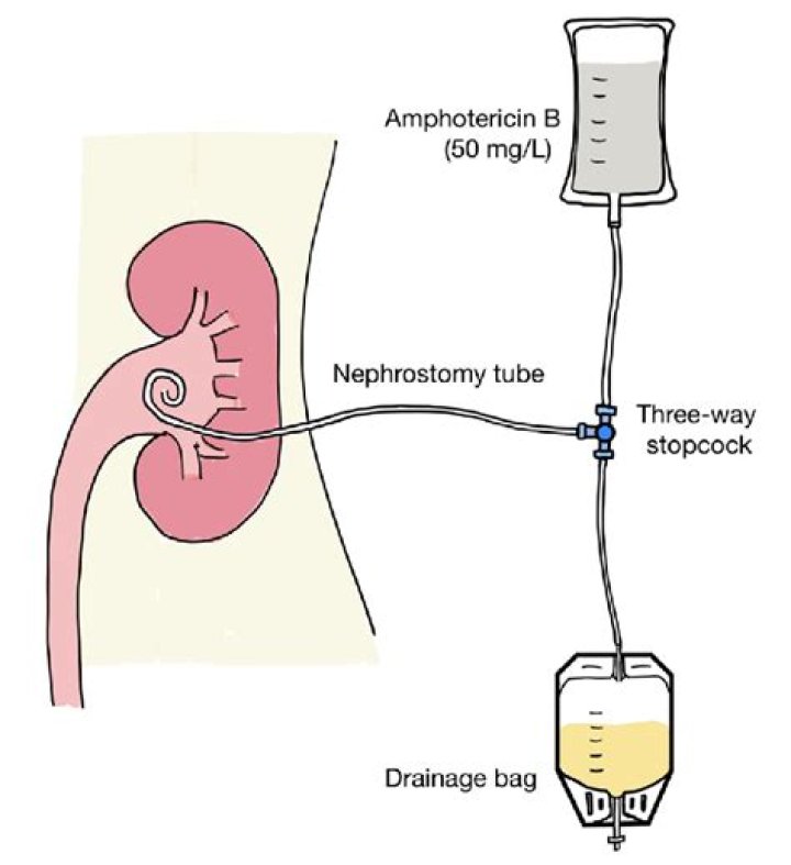 nephrostomy bag