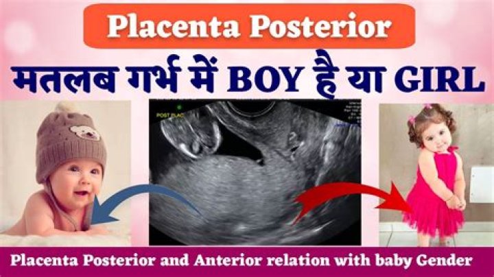 placenta anterior means boy or girl