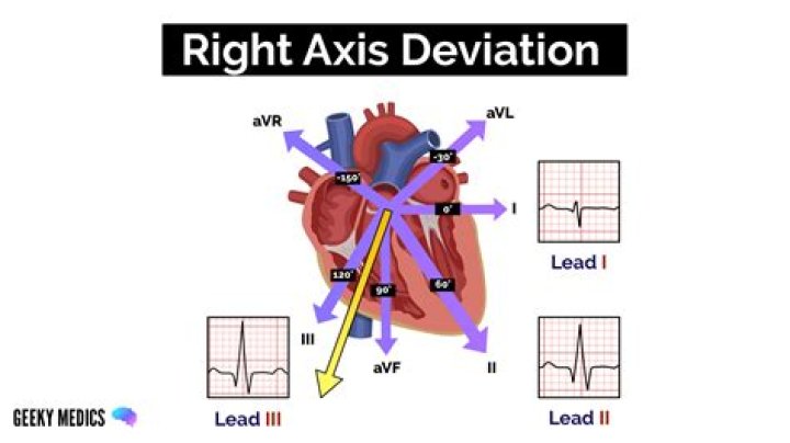 right axis deviation