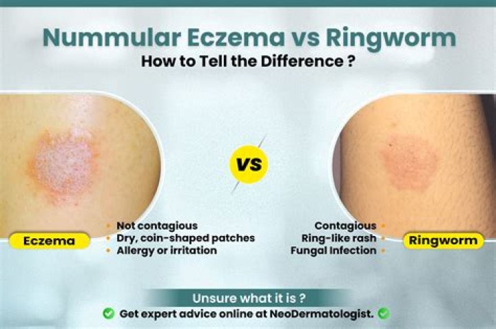 ringworm vs eczema