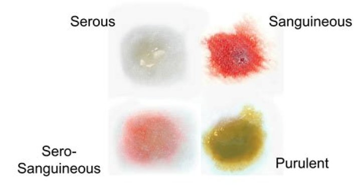 serosanguinous
