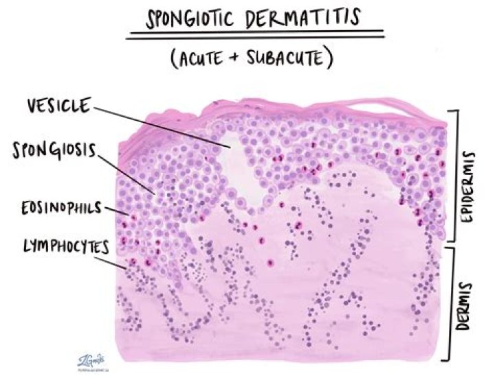spongiotic dermatitis