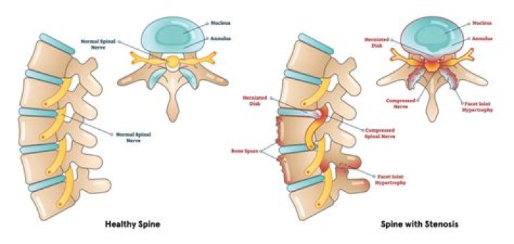 stenosis medical term