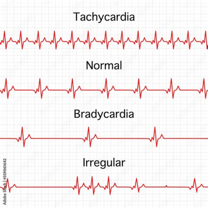 tachy medical term