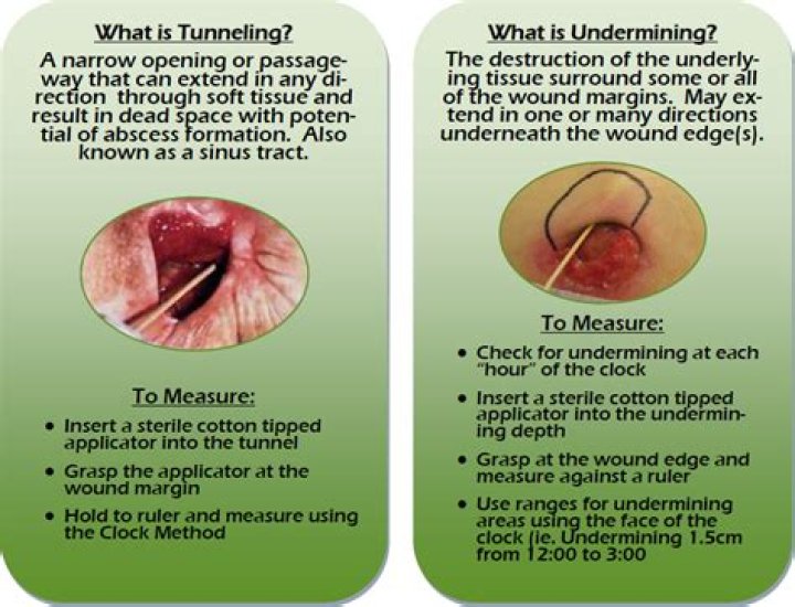 tunneling wound