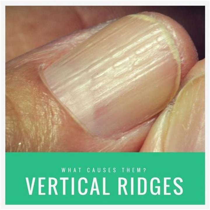 vertical ridges on nails vitamin deficiency