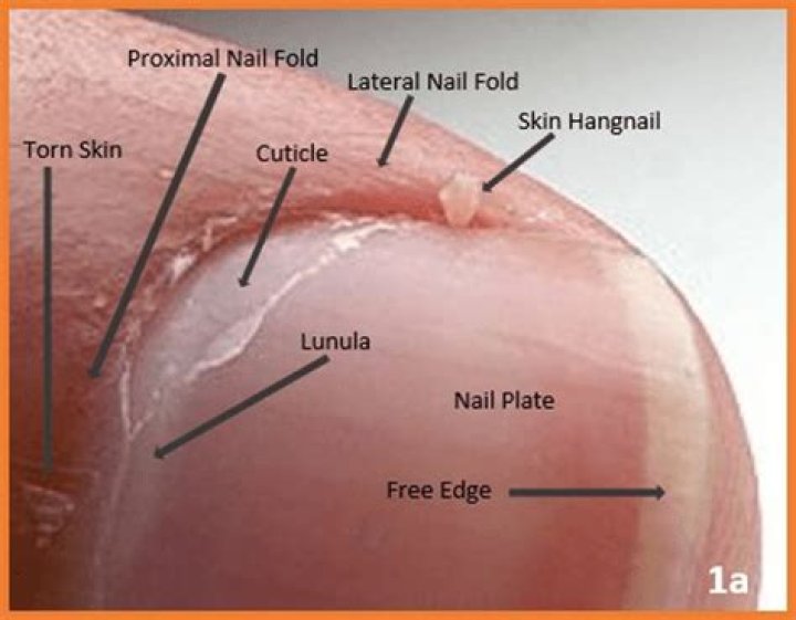 what is a hangnail